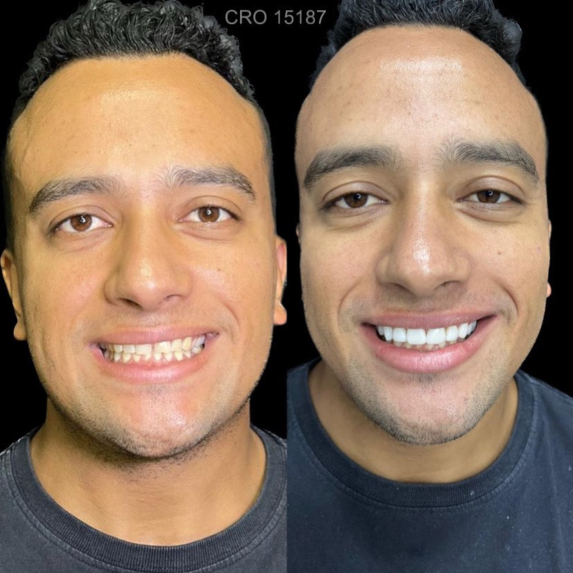 Transformação de Sorriso 10